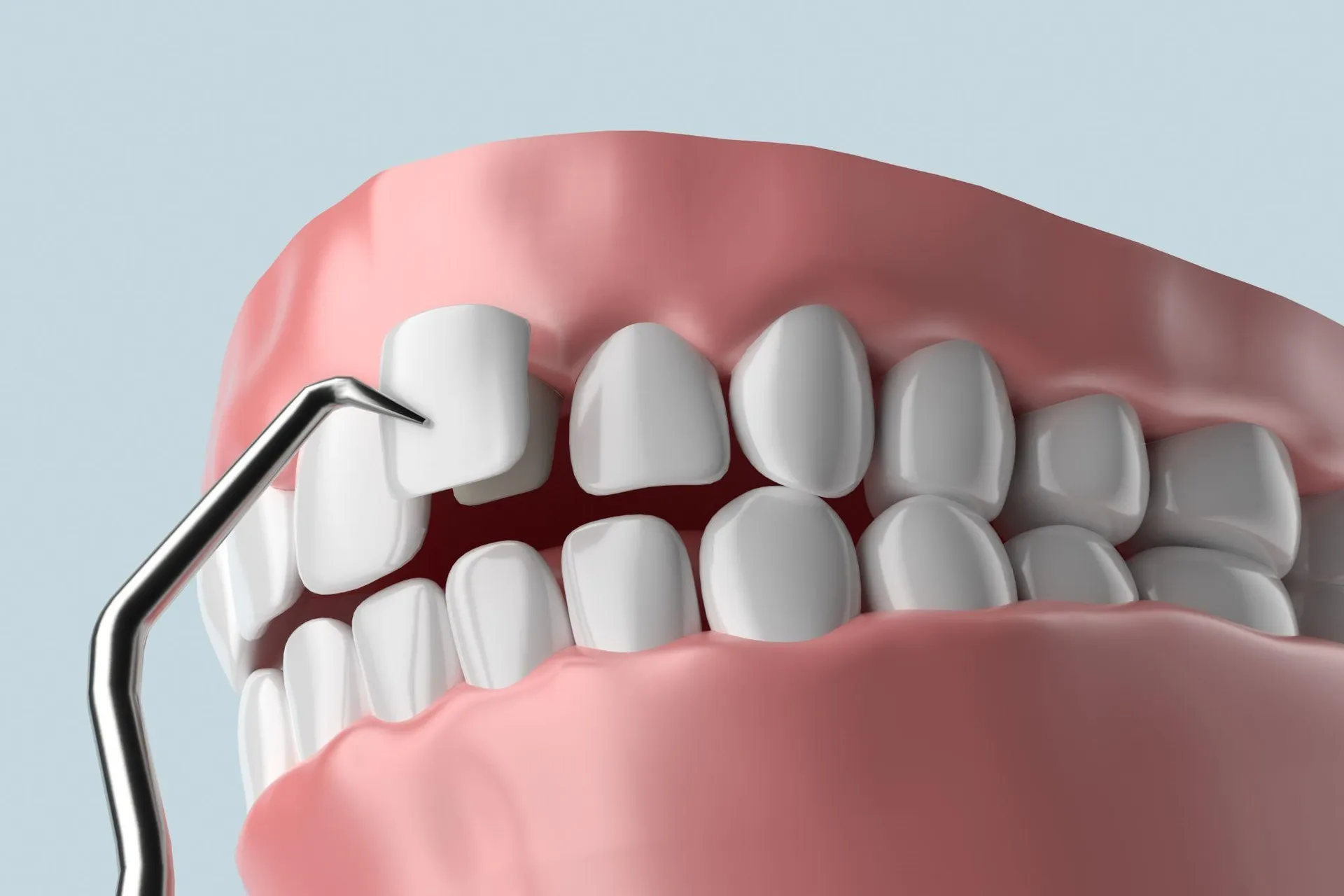 Porcelain dental veneers