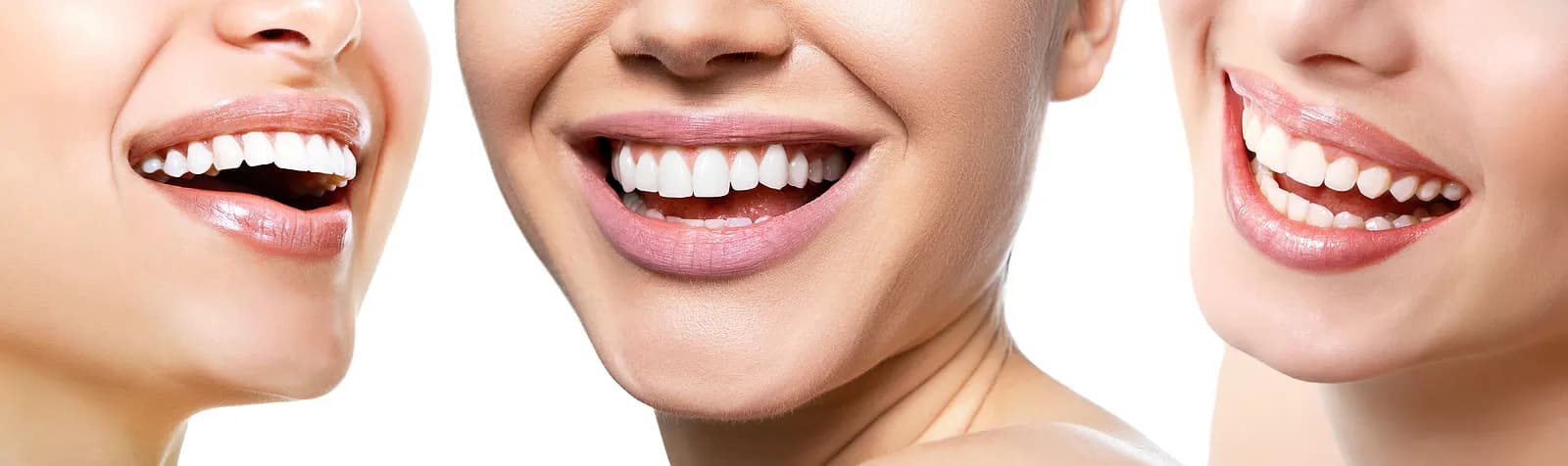 Bright white smile after teeth whitening